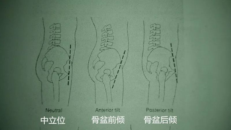 ▼方法1:髂前上棘和髂后上棘的竖直线