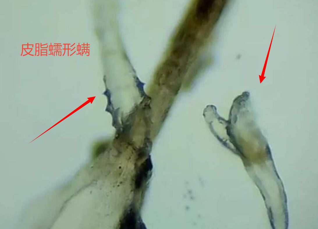 还用硫磺皂除螨？醒醒吧！内行人都用这1物，螨虫立马逃之夭夭