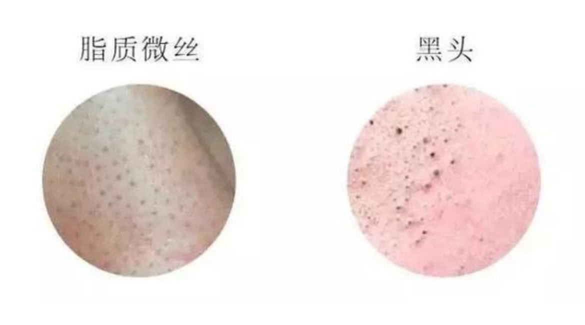 鼻子一捏就出成条“黄色垃圾”？教你3招净化法，毛孔通畅无阻