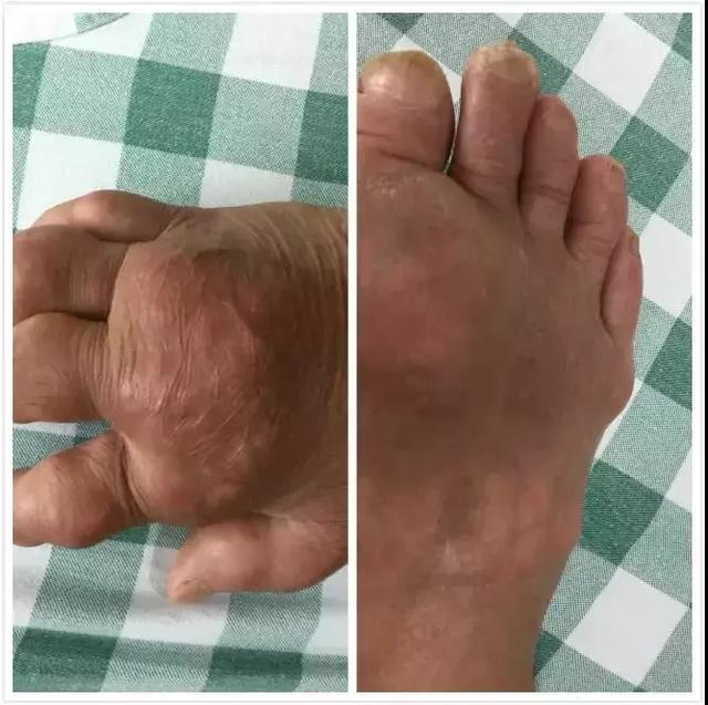 痛风石缠身?这3个“溶石”的药方值得一看!