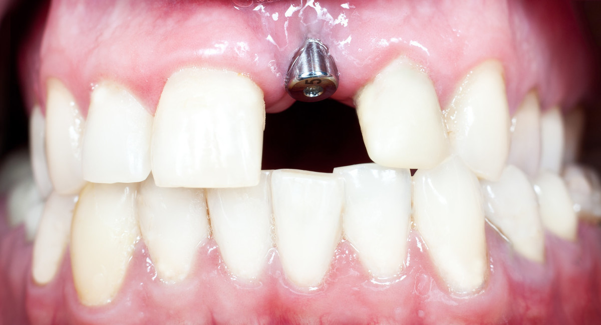 镶牙和种植牙有什么区别?该怎么选?牙科医生一语道破玄机