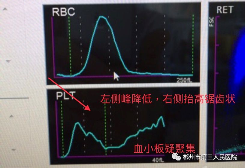 第三步"观察仪器报警提示及血小板直方图",当重抽复查血小板仍出现