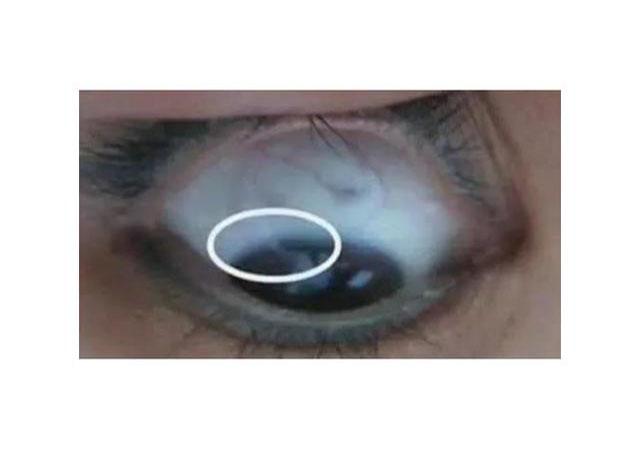 望眼部,辩症状,看一眼你的眼睛就知道有什么病