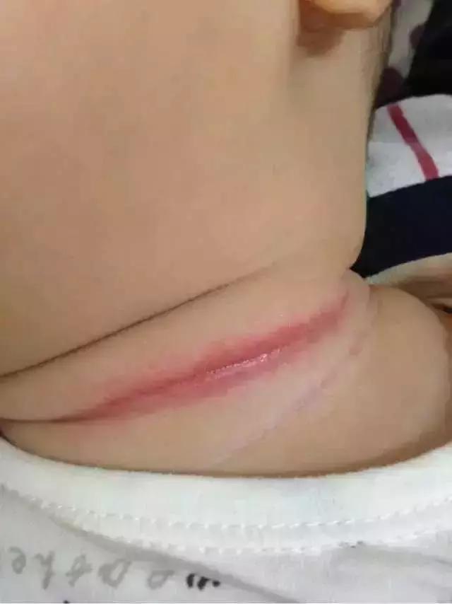 高温夏季来袭,宝宝除了长痱子以外,还要注意“淹脖子”问题