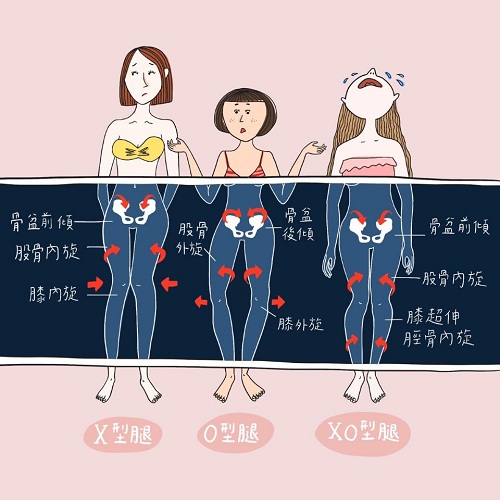 骨盆前倾vs.后倾,也会影响腿型