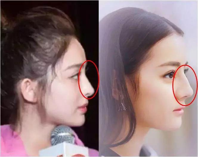 12岁整鼻到20岁还没拆绷带，只是为了炫富？