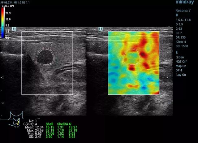 迈瑞剪切波弹性技术闪耀RSNA2018