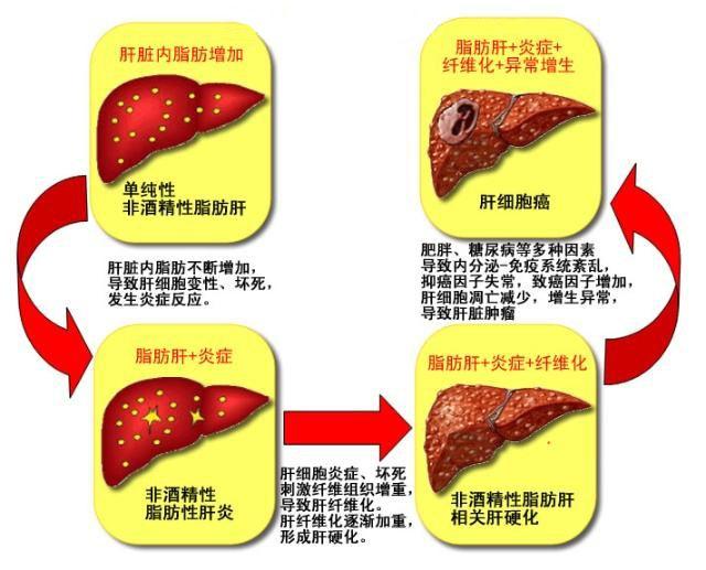 得了脂肪肝,过度节食,运动反而是伤害?如何正确护理脂肪肝?