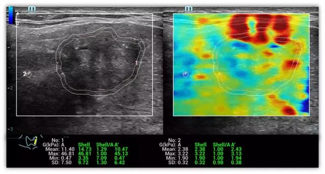 迈瑞剪切波弹性技术闪耀RSNA2018