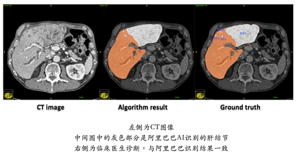 阿里AI肝病诊断两夺世界第一：至今无人超越