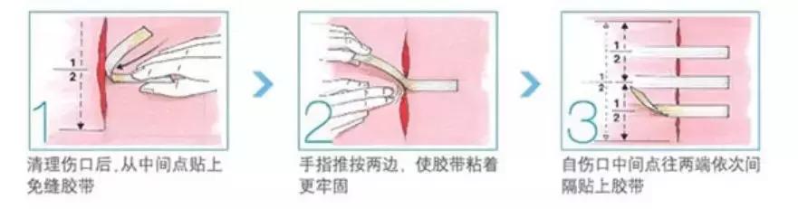 血管破了，原来可以用胶带补？