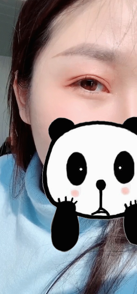 张雨绮打在腋下狐臭处的针,林允缺钱也打了脸