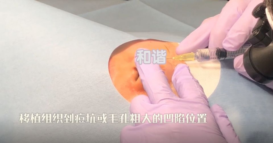 迷死氧日本亲身体验2，我用脖子上的皮给自己缝了毛孔