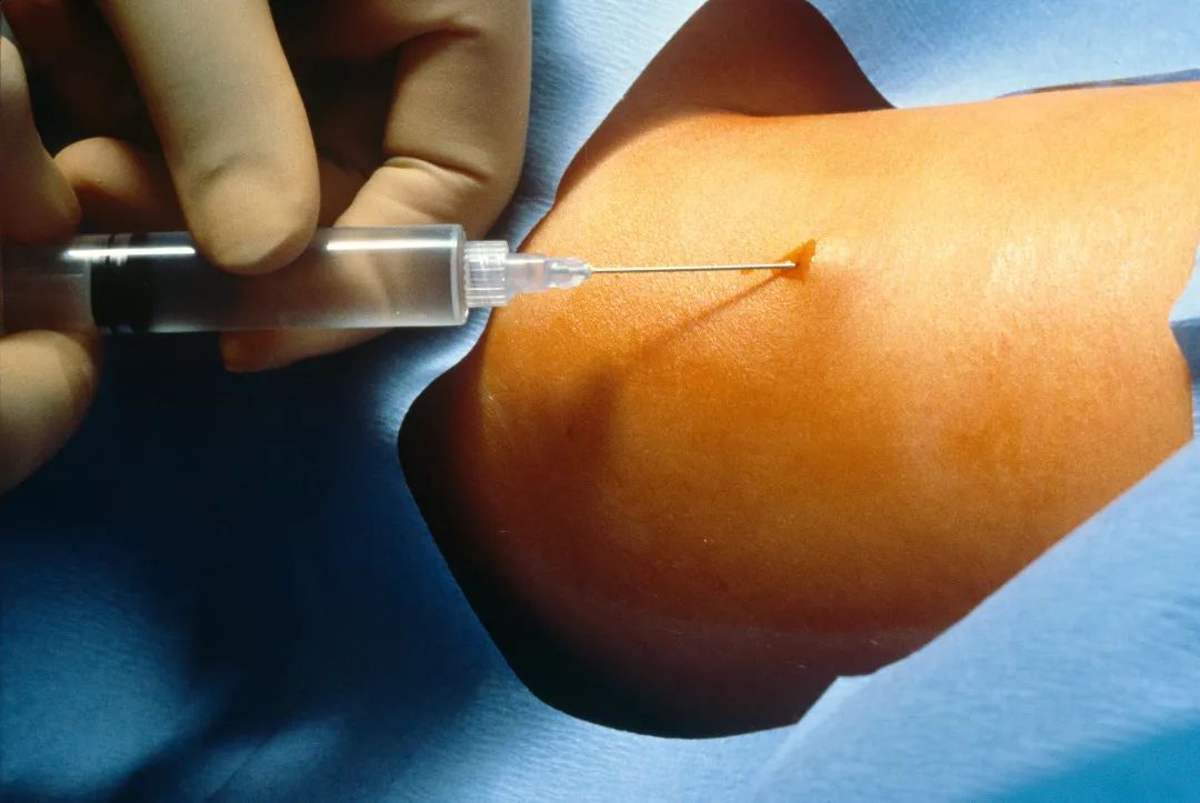 皮下埋植手术过程中 / 视觉中国