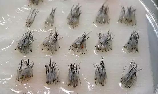 外国人治疗脱发的姿势，越来越骚了……