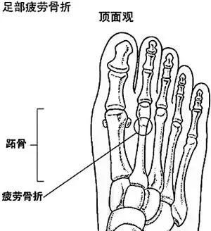 ② 如果负重感到疼痛,应该使用拐杖(伤肢不负重)或石膏,支具制动