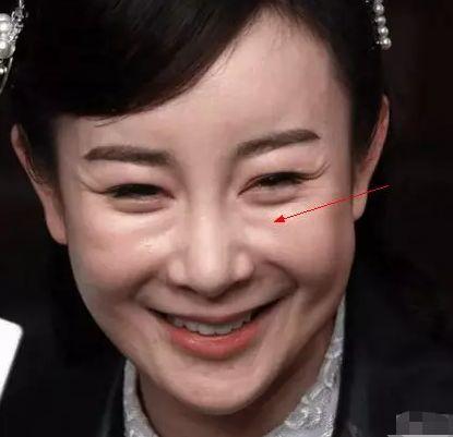 林允儿的神颜也崩了！脸歪+填充成气球，这两道沟又是什么鬼？