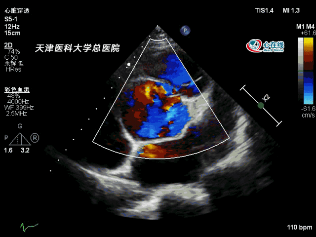 彩色胸骨旁升主动脉短轴切面可见真腔及假腔内的血流(假腔小,真腔
