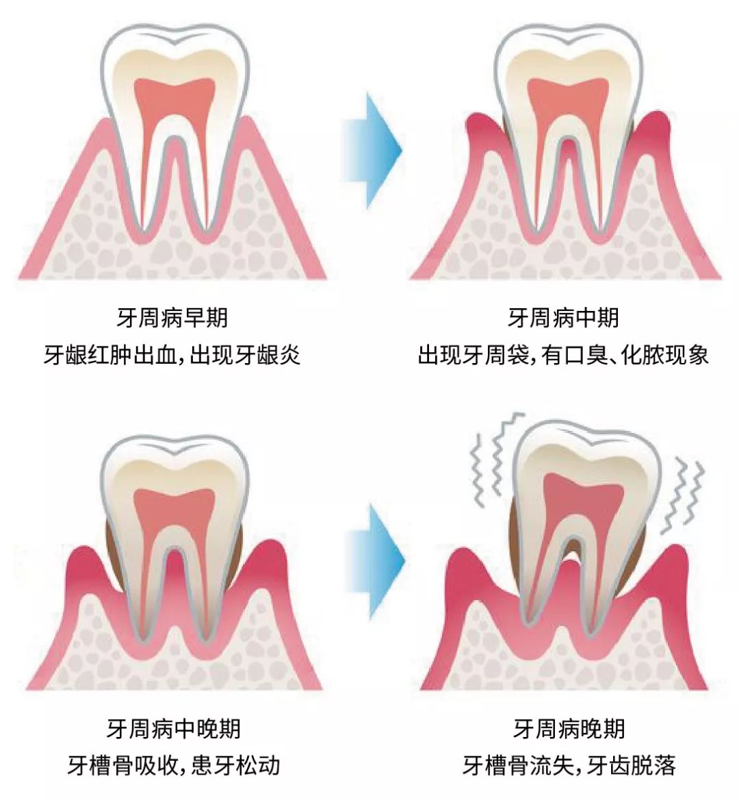 日本百年品牌~专攻牙周病牙龈出血的药用牙膏!舒缓口腔清新口气!