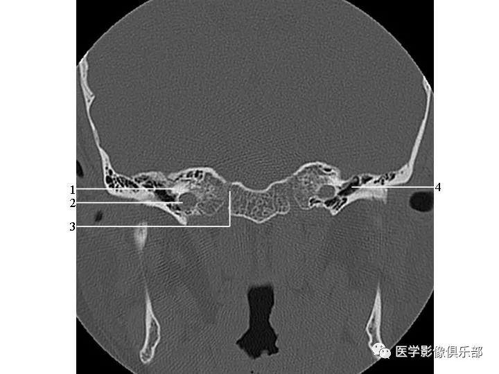 1上半规管 2后半规管 3上半规管 4总脚 5弓下管 (二)冠状面
