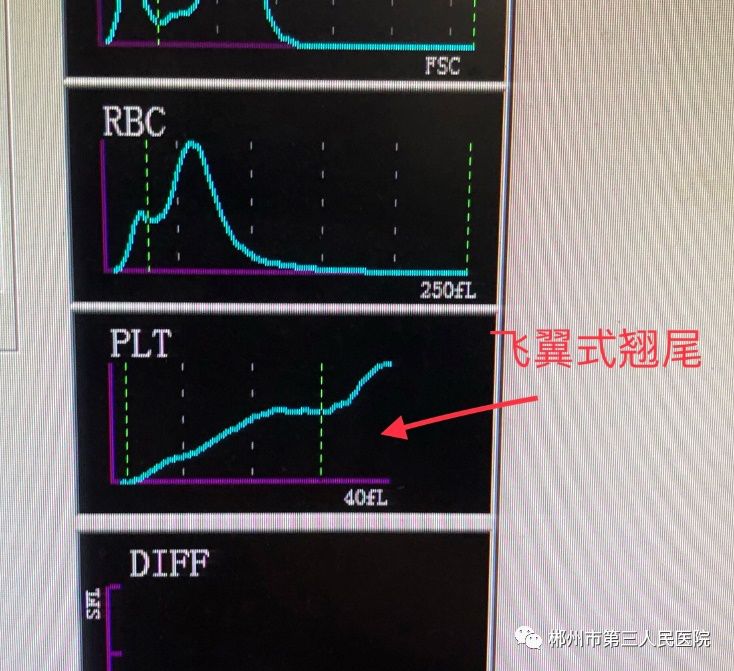 第三步"观察仪器报警提示及血小板直方图",当重抽复查血小板仍出现