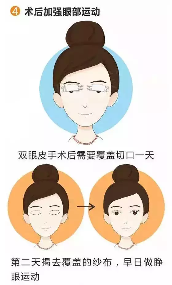 图解双眼皮术后护理的注意事项