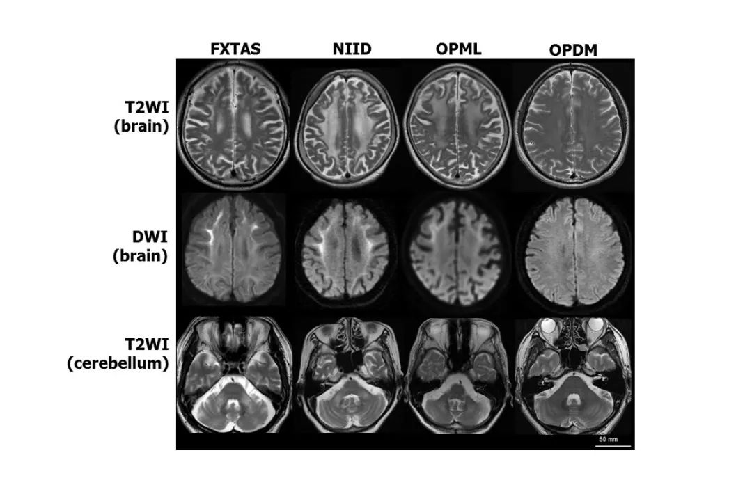 Nature子刊:这个基因竟与四种罕见神经退行性疾病都有关 银河娱乐官网下载