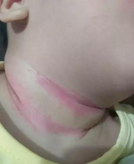 高温夏季来袭,宝宝除了长痱子以外,还要注意“淹脖子”问题