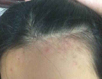 发际边缘长痘是什么原因