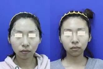 回春没多久的杨紫，咋又肿成这样了？