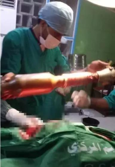这都能活!榴弹嵌脸里,RPG插大腿,为啥这些炮弹没有炸?