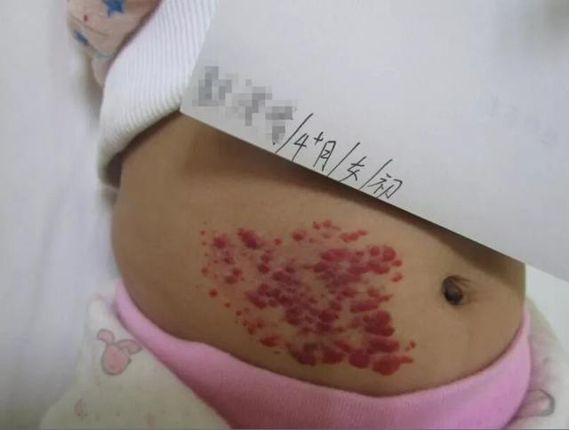 婴幼儿时期的血管瘤可以长大了再治疗吗?血管瘤不治疗会怎么样?