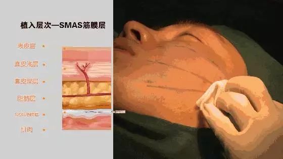 联系一 smas筋膜层弹性好,力量大