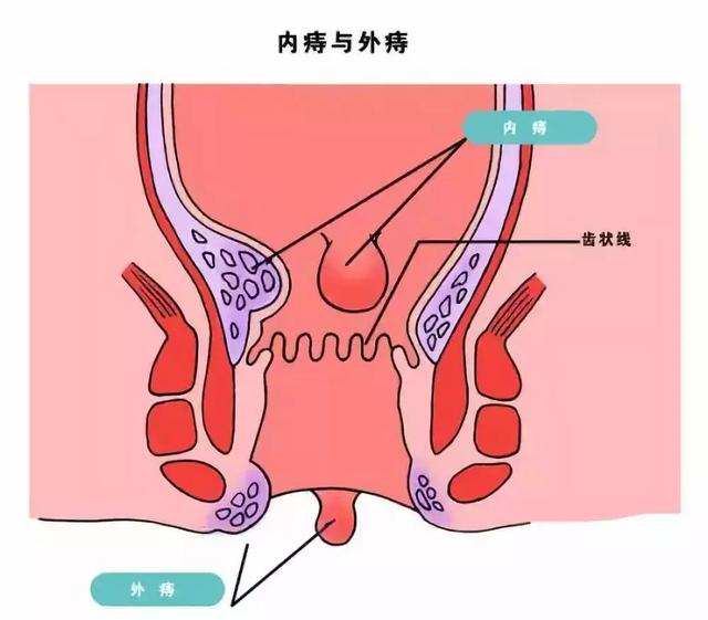 十人九痔必须重视做好这4件事助你远离痔疮