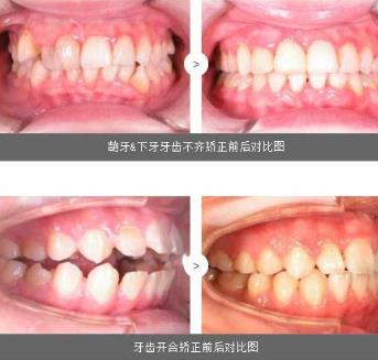 矫正牙齿的费用是多少