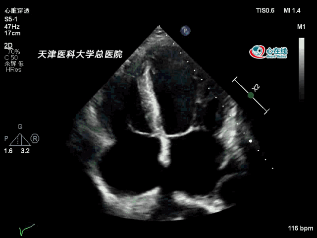 二维心尖4腔切面显示全心增大,左心室室壁运动普遍减弱,房间隔