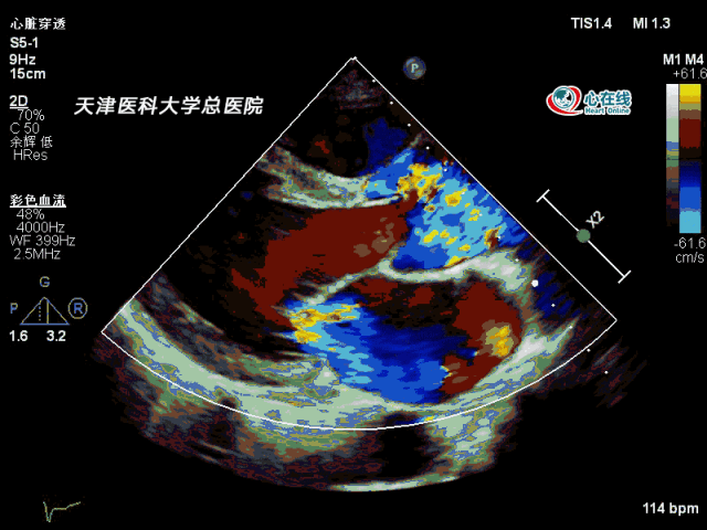 彩色胸骨 旁左心室长 轴切面显示主动脉瓣重度反流,二尖瓣中度反