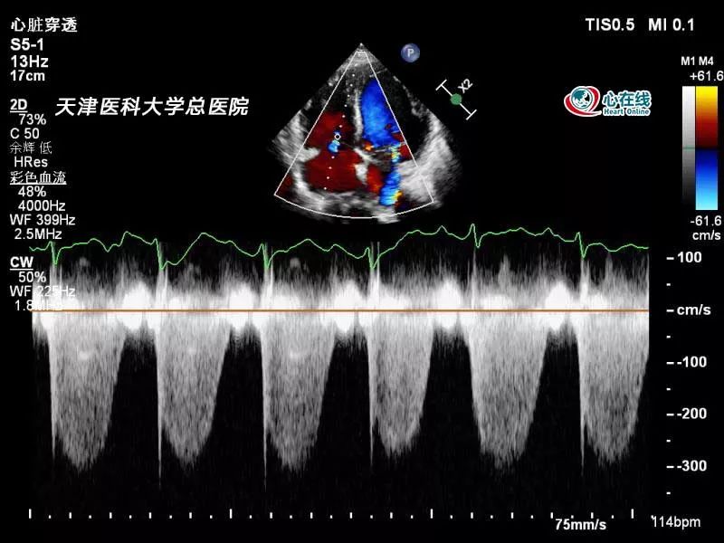 三尖瓣反流cw频谱图提示肺动脉高压(收缩压约为40 mmhg).