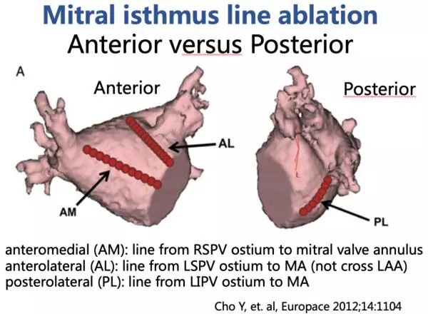 hrs2019 中国之声∣董建增:二尖瓣峡部线性消融,前壁线还是后壁线?