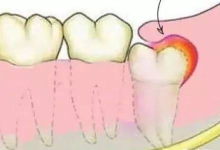 4.智齿冠周炎