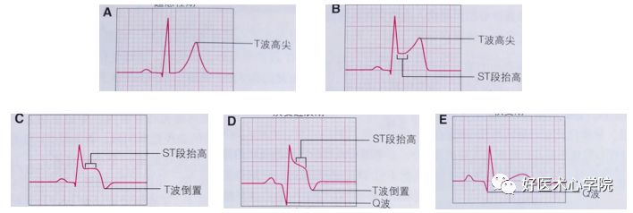 心电图表现 stemi的典型心电图