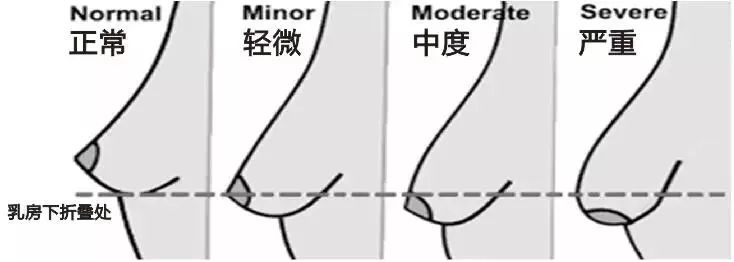 即使胸看上去是有点垂的, 这很正常,毕竟乳房有重量, 这么悬在半空