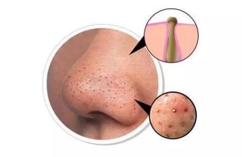 闭口和痘痘之间有什么关系?(临沂中科皮肤病医院)