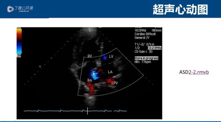 超声心动图:一文搞定右心超声造影