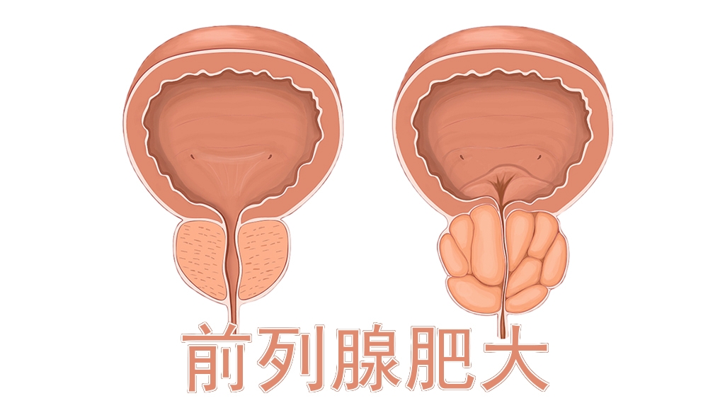 潘氏中医:男性前列腺增大的病因是什么呢?