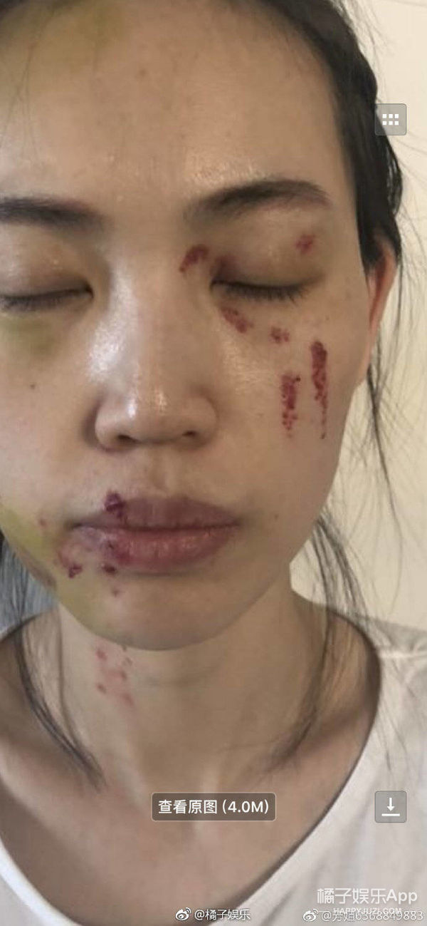 马蓉验伤报告曝光 邱晨自曝患癌