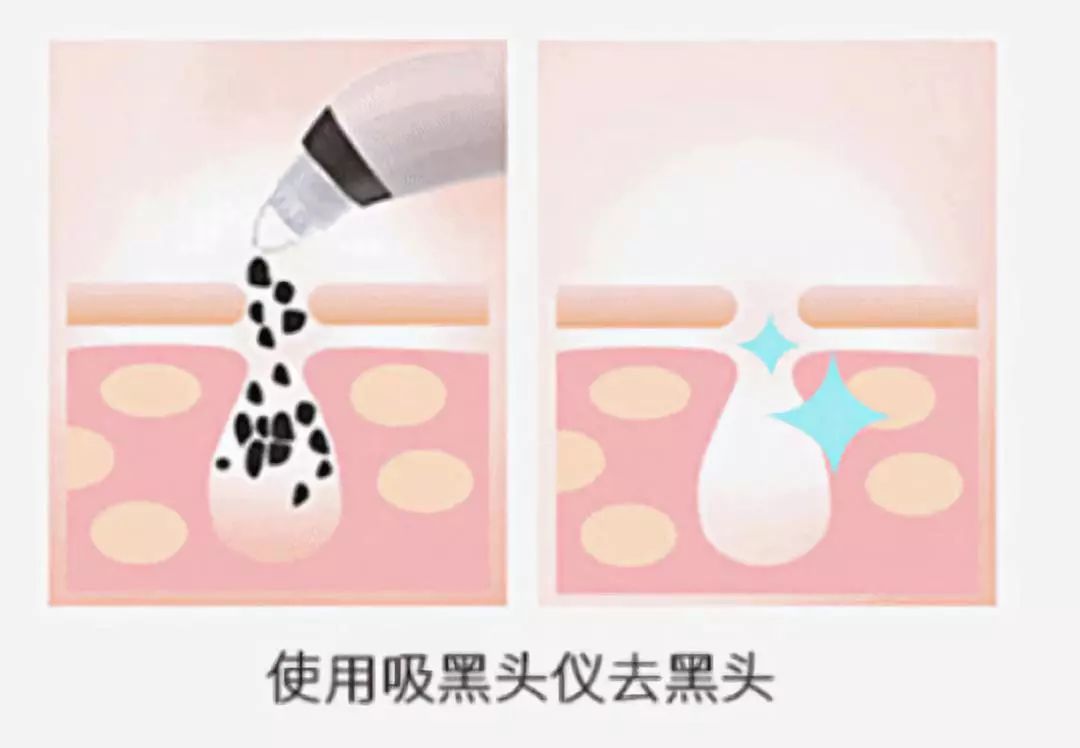测评了3款超火的去黑头神器,最有用的是
