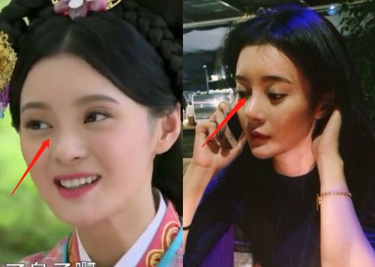 王凯初恋整成低配版沈梦辰！连她整形后遗症的朝天鼻也照搬了···