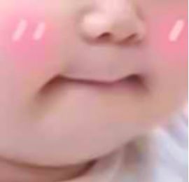 迷死氧亲身体验，我去日本整了一个纯天然鼻子