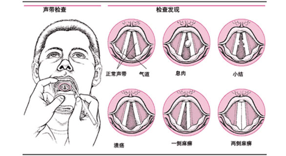 注意经常唱歌,用嗓过度,易患声带小结_凤凰网健康_凤凰网